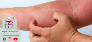 allergia nichel dermatite cosmetici settimo senso riccione
