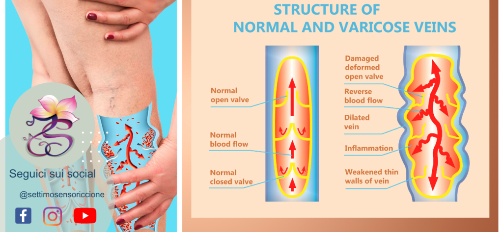 gambe gonfie varicose rimodellamento corporeo metodo Settimo Senso® Riccione