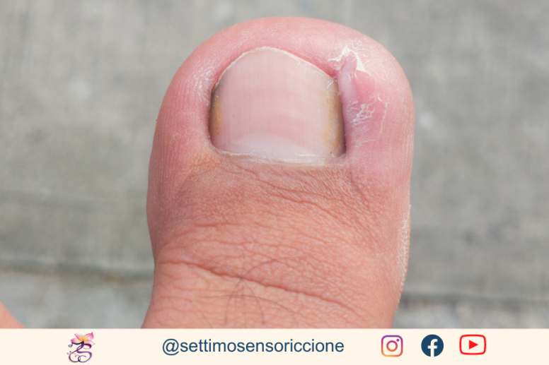 Pedicure curativo unghia incarnita metodo Settimo Senso Riccione (1)