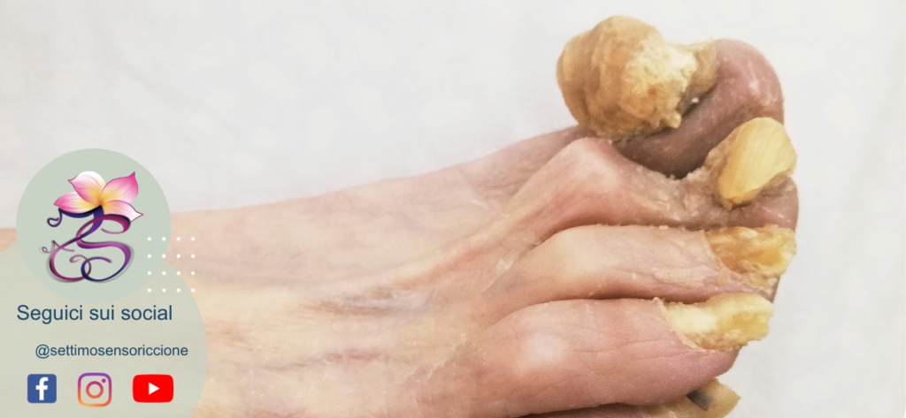 onicogrifosi unghie deformi spesse piedi metodo Settimo Senso Riccione